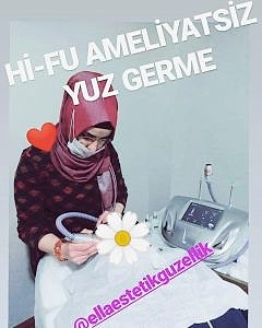 yüz germe