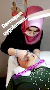 dermapen uygulaması